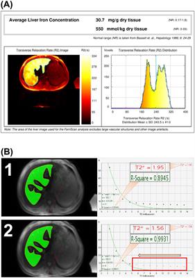 Assessing the accuracy of CMRtools software for diagnosing liver iron overload in thalassemia patients: influencing factors and optimisation strategies